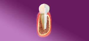implante dentário